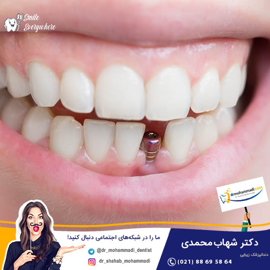 دلایل از دست دادن دندان چیست و چرا باید ایمپلنت دندان انجام دهم؟ - کلینیک دندانپزشکی دکتر شهاب محمدی